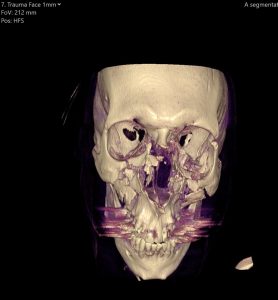 X-Ray image of the Bishop of Southwark's skull